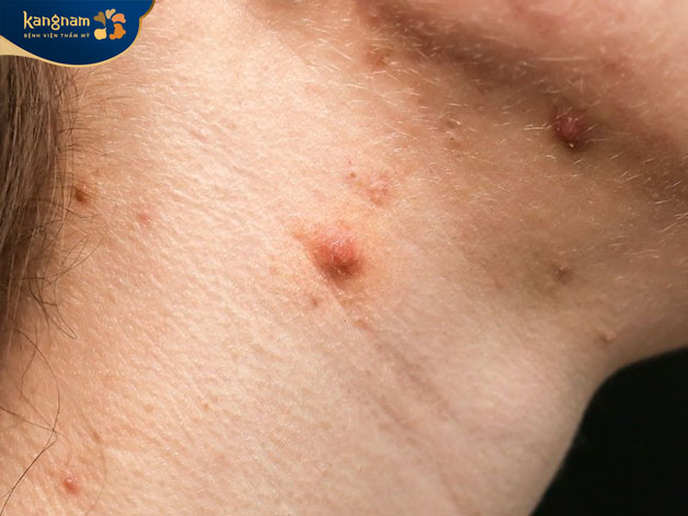 Một số loại thuốc khi sử dụng sẽ gây ra tác dụng phụ làm nổi mụn