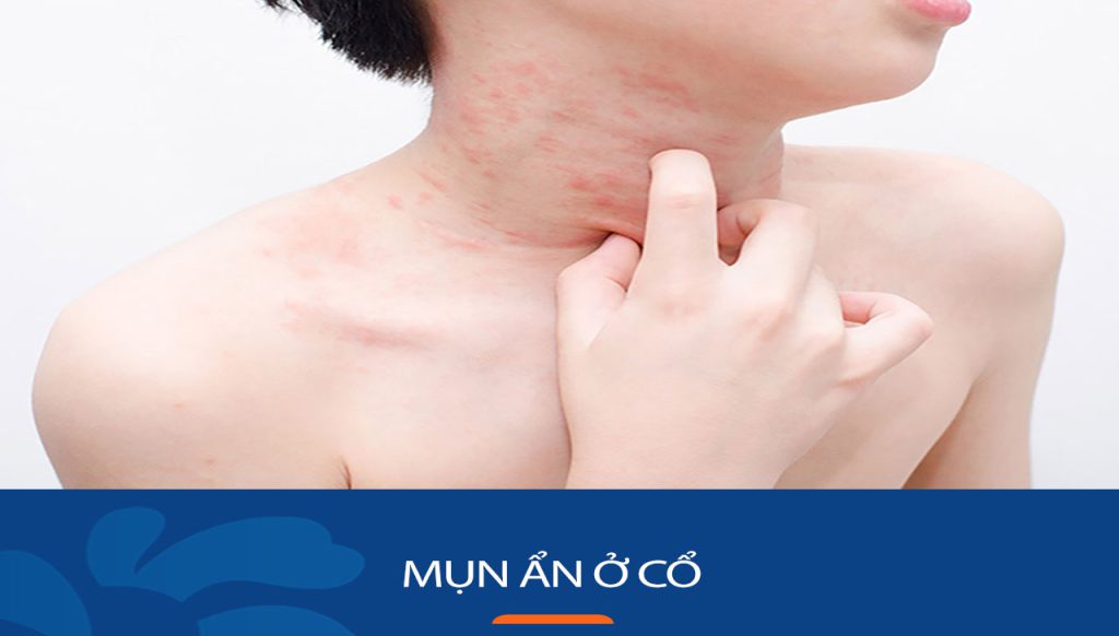 Bí quyết trị mụn ẩn ở cổ DỨT ĐIỂM, không thâm, không sẹo!