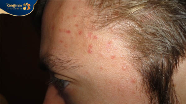 Mụn hình thành ở thái dương có thể do bệnh ở túi mật, gan, thật