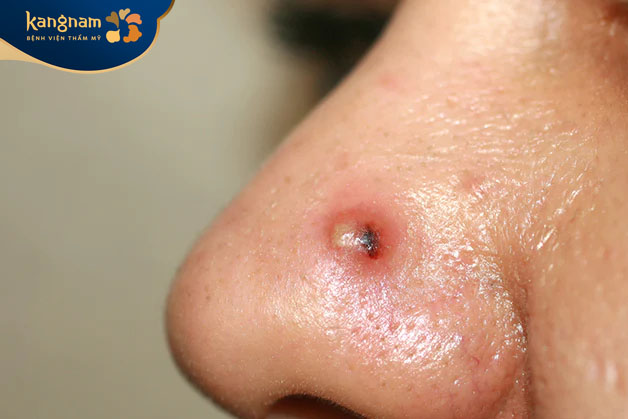 mụn mủ có khả năng tự hồi phục sau vài ngày đến 1 tuần