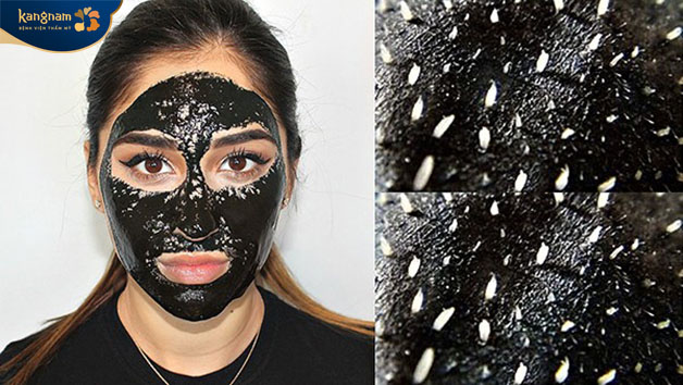 Khi lột đi lớp mặt nạ mụn sẽ ra theo 