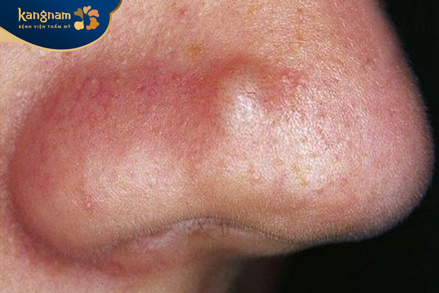 Một số trường hợp mụn mủ tự hết