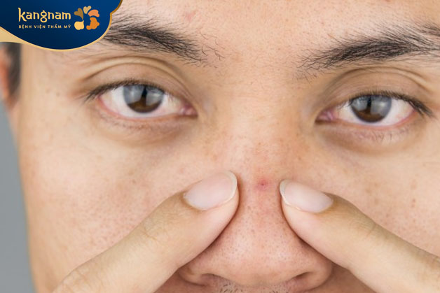 Không nên nặn mụn trên mũi vì dễ để lại vết thâm