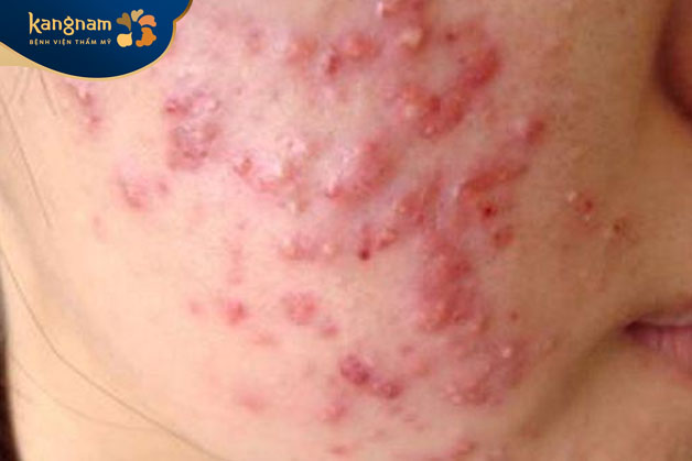 Mụn viêm đỏ ở má gây mất thẩm mỹ