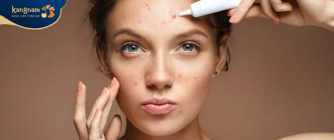 Những lưu ý khi điều trị mụn