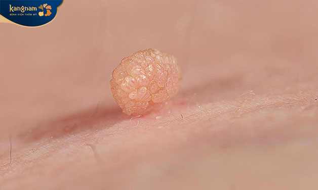 Mụn thịt dư có thể xuất hiện ở vai, ngực, lưng..