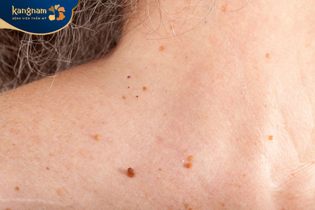 Loại mụn này thườn xuất hiện ở những người có làn da lão hóa