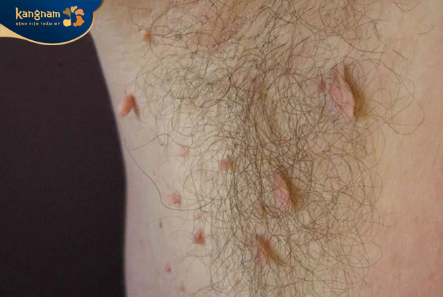 Mụn thịt dư lộ rõ có thể mọc ở bất cứ đâu, kể cả nách