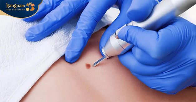 Đốt mụn bằng tia laser là phương pháo được nhiều người lựa chọn