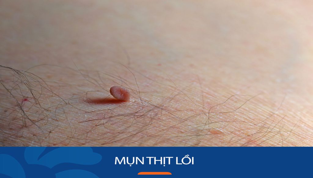 Mụn thịt bị lồi: Nguyên nhân, cách điều trị và phòng ngừa