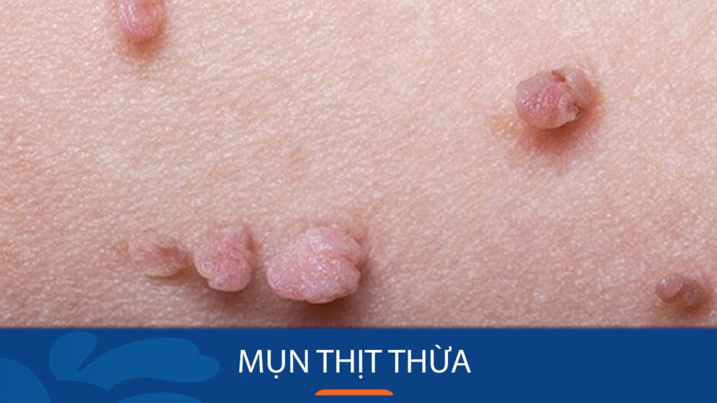 Mụn thịt thừa: Loại bỏ mụn thịt thừa an toàn, nhanh chóng tại nhà