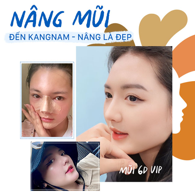 Nâng mũi 6D sử dụng sụn tự thân và sụn nhân tạo cao cấp