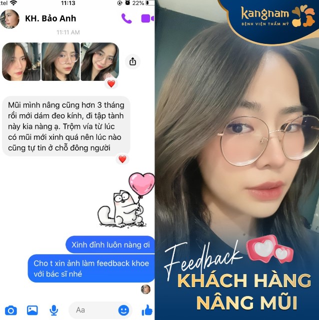 Bạn Bảo Anh feedback nâng mũi sau 3 tháng