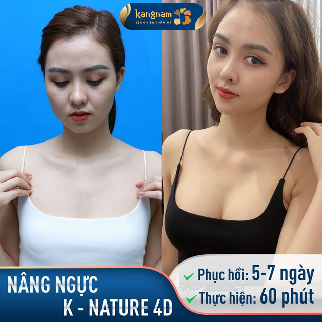 Nâng ngực K-Nature 4D