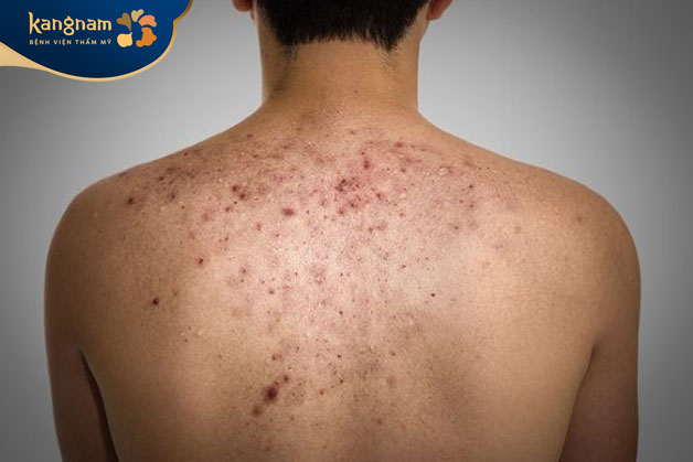 Mụn lưng ở nam giới