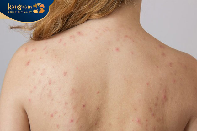 Mụn viêm ở lưng