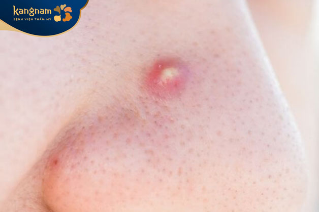 Tiếp xúc với ô nhiễm, ánh nắng mặt trời quá mức gây mụn