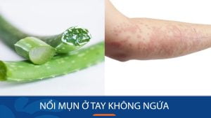 Nổi mụn ở tay không ngứa: Nguyên nhân, Cách điều trị và Phòng ngừa