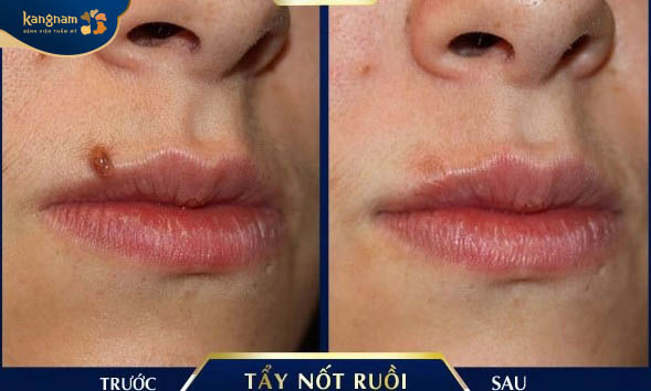 Mờ nốt ruồi sau khi tẩy