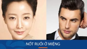 Nốt ruồi ở miệng: Giải mã ý nghĩa & Lời khuyên tẩy nốt ruồi