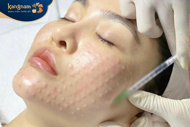 Tiêm Meso không gây hại đến da