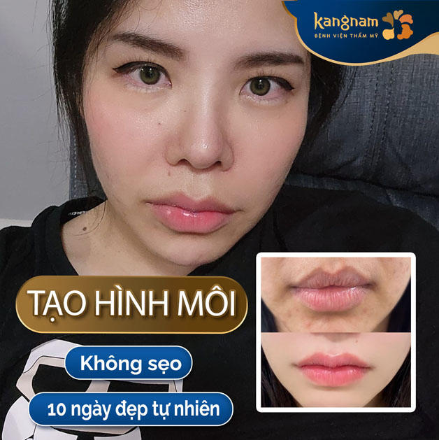 Tạo hình môi tim 6D