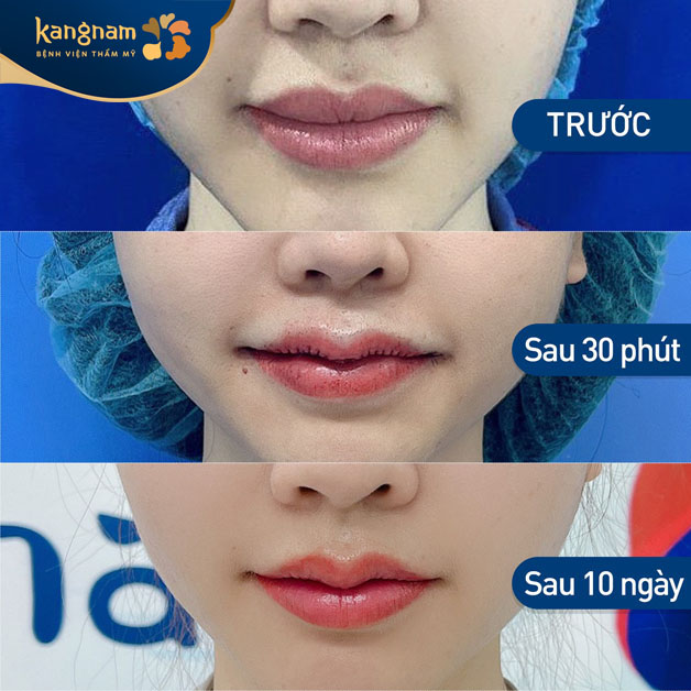 Quá trình tạo hình môi an toàn, hạn chế xâm lấn, không sưng