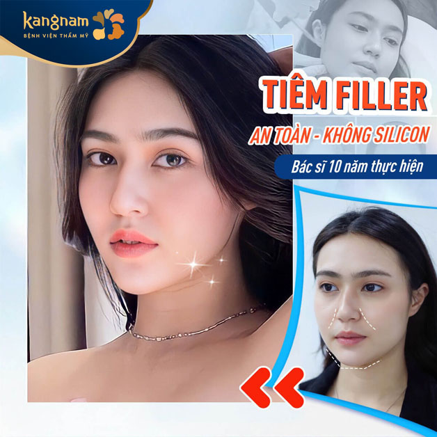 Tiêm filler an toàn, kết quả đẹp tự nhiên