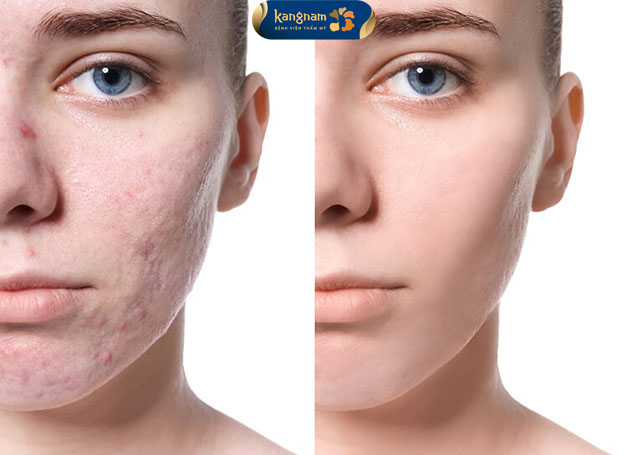 sẹo lõm trên da mặt sẽ không còn sau khi tiêm filler