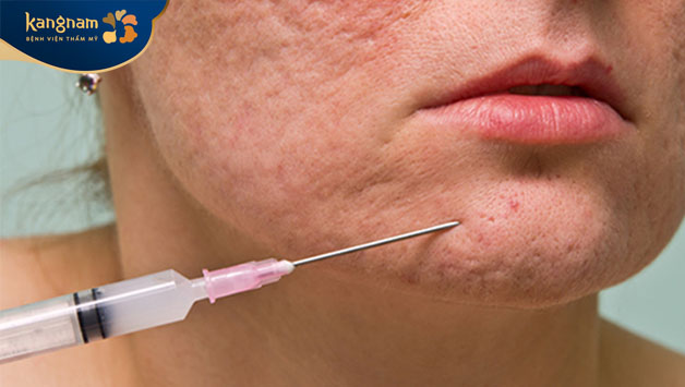 Phương pháp chỉ hiệu quả trong một thời gian nhất định nên sẽ cần duy trì tiêm lại