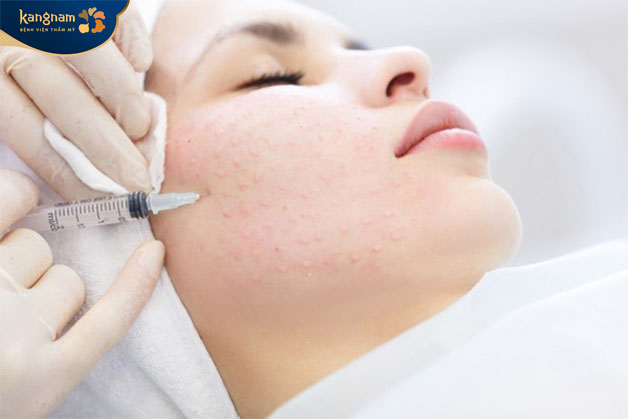 Hoạt chất sẽ đi sâu vào trong da làm đầy vết rỗ