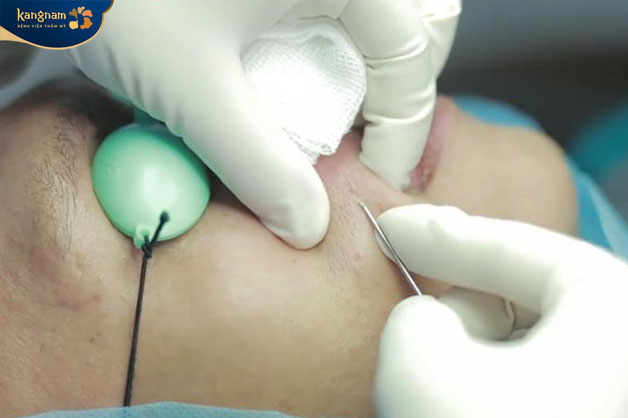 Cắt đáy sẹo giúp loại bỏ hoàn toàn mô sẹo xơ cứng