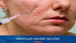 Tiêm filler làm đầy sẹo lõm: Giải pháp hiệu quả cho da mịn màng?
