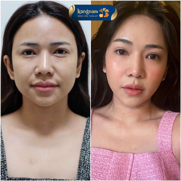 Tạm biệt rãnh rồng già nua, lấy lại vẻ tươi trẻ rạng ngời