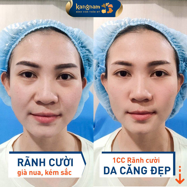 Tiêm filler rãnh cười trẻ trung