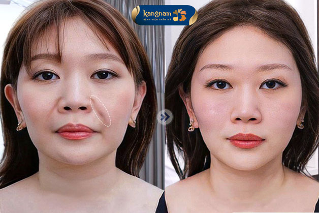 Xóa rãnh rồng, giúp chị khách trẻ ra 5 tuổi