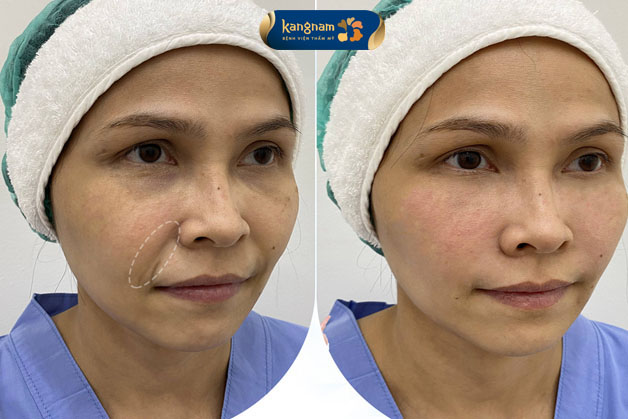 Xóa nếp nhăn khóe mạnh chỉ sau 1 lần thực hiện