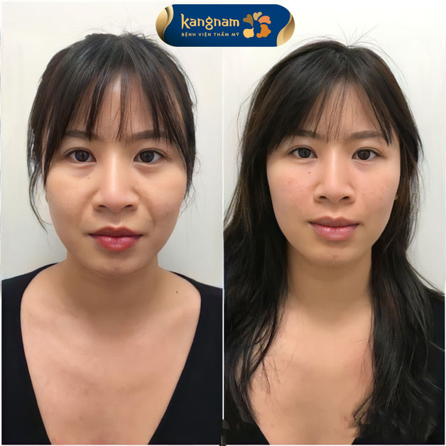 Khách hàng trước và sau khi lấp đầy rãnh cười