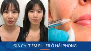 Địa chỉ tiêm filler ở Hải Phòng an toàn, FDA chứng nhận