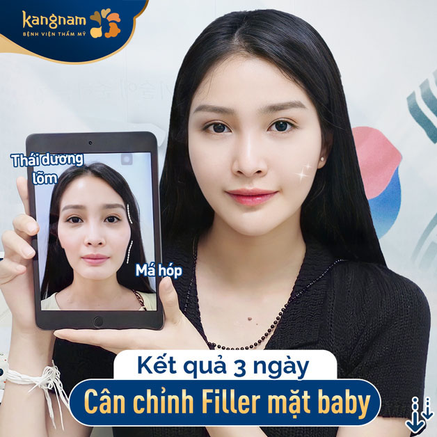 Tiêm filler làm đầy thái dương