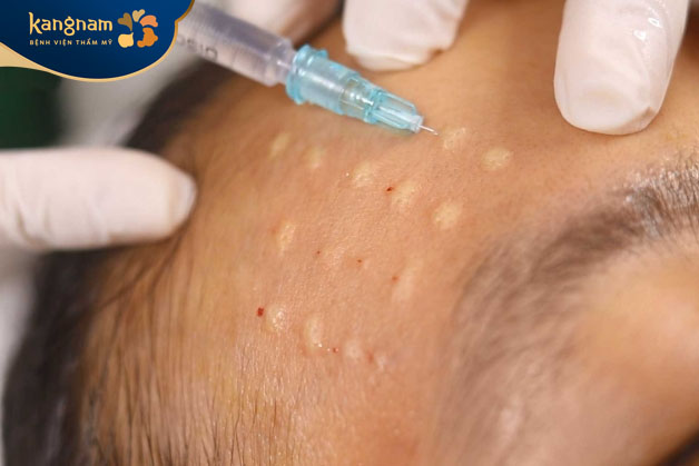 Cấy Meso Extra là phương pháp không xâm lấn