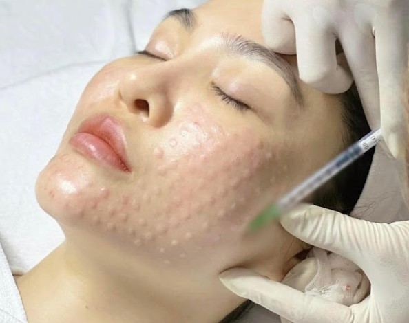 tiêm mesotherapy có an toàn không