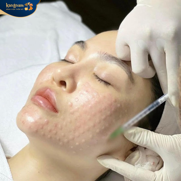 Tiêm meso không hề gây ra cảm giác đau đớn hay khó chịu 