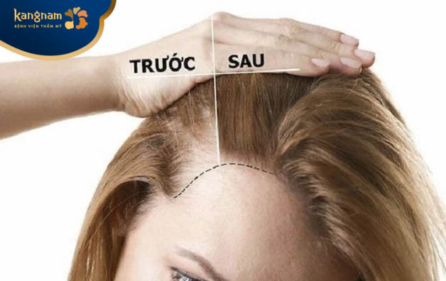 Hiệu quả tiêm mesotherapy mọc tóc kéo dài bao lâu, có vĩnh viễn không?