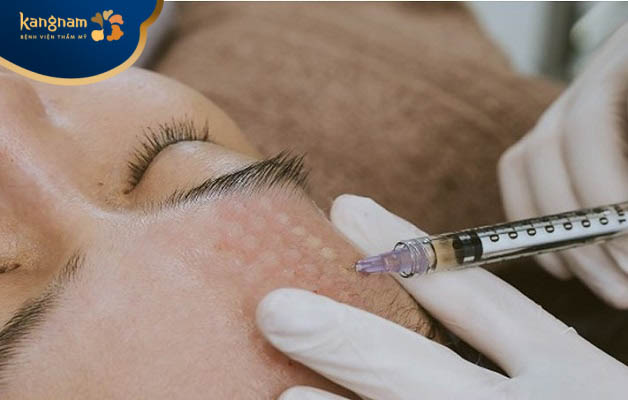 Tiêm meso có trị được mụn không? 