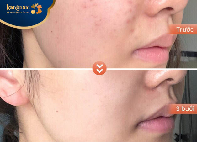 Mặt bị mụn có tiêm meso được không