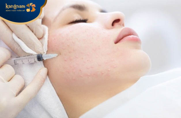 Phương pháp tiêm meso điều trị mụn