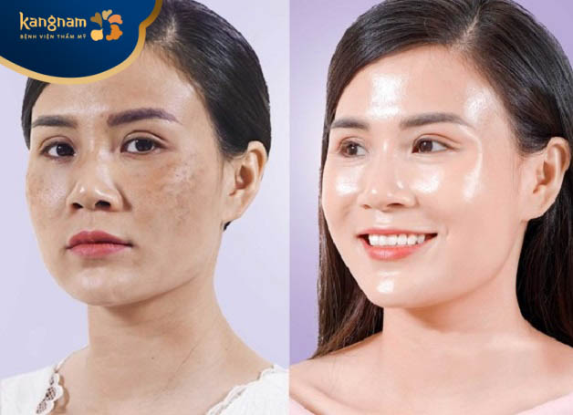 Đối tượng nên tiêm meso để trị nám da