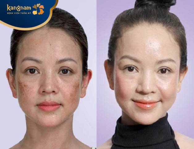 Tiêm meso điều trị nám bao lâu có kết quả?