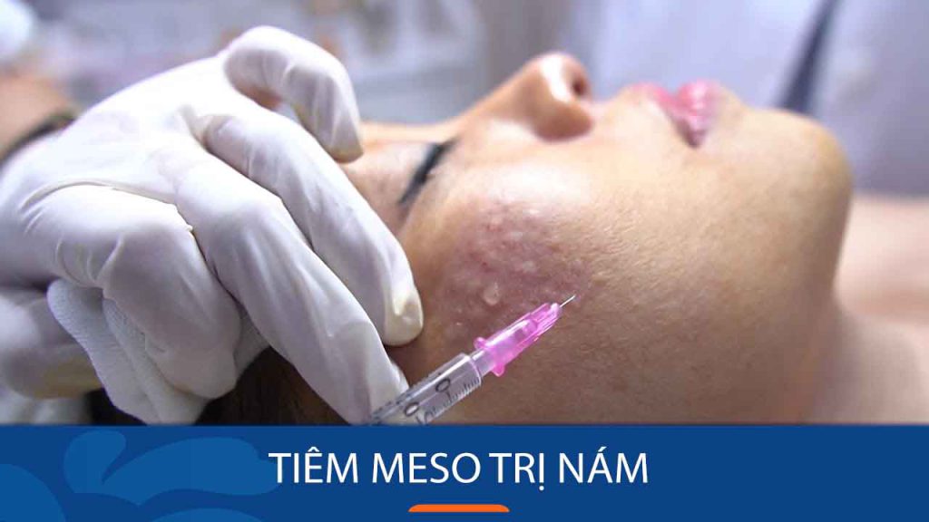 Tiêm meso trị nám: Giải pháp cho làn da trắng sáng mịn màng